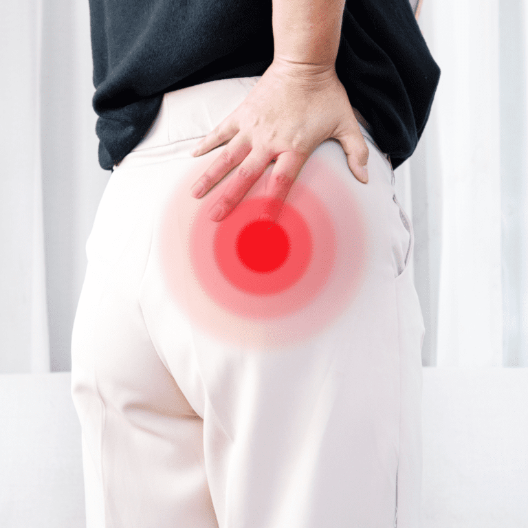 Piriformis Syndrome